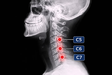 hernia cervical c5-c6 incapacidad